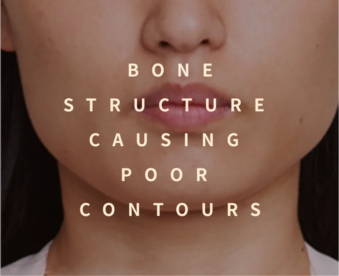 Bone Structure Causing Poor Contours