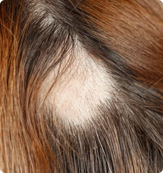 圓形禿、壓力禿