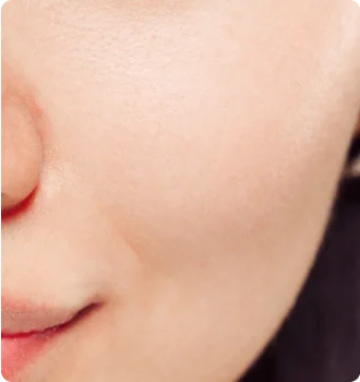 Sagging and Loose Cheeks