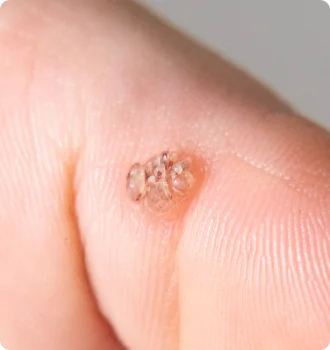 Viral Warts