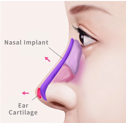 Two-stage Rhinoplasty