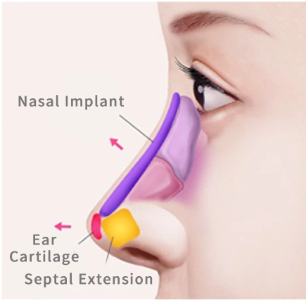Three-Stage Rhinoplasty