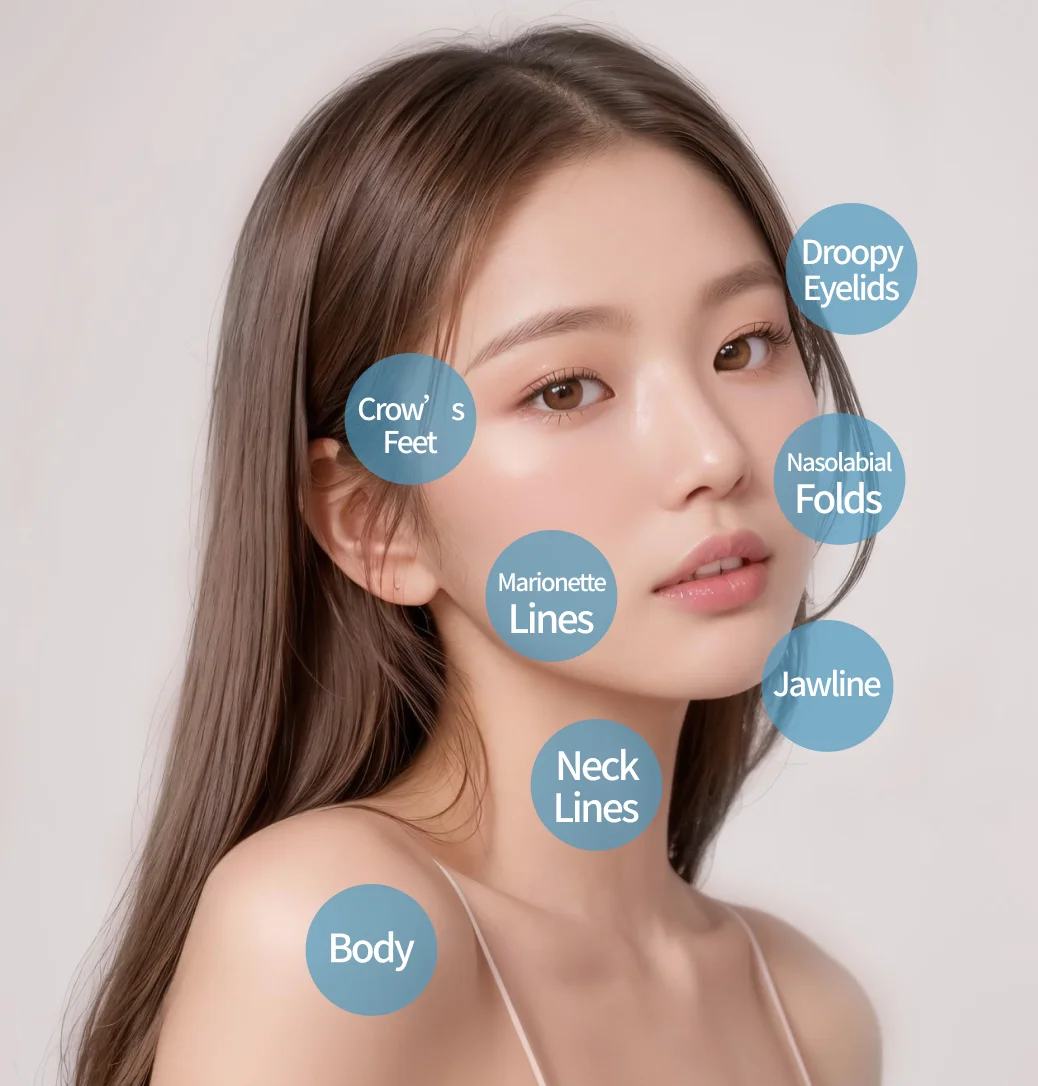 Treatment areas - nasolabial folds, marionette lines, jawline, droopy eyelids, crow's feet, neck lines, body