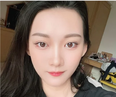 更多案例-打造電眼雙眼皮！告別疲勞無神泡泡眼