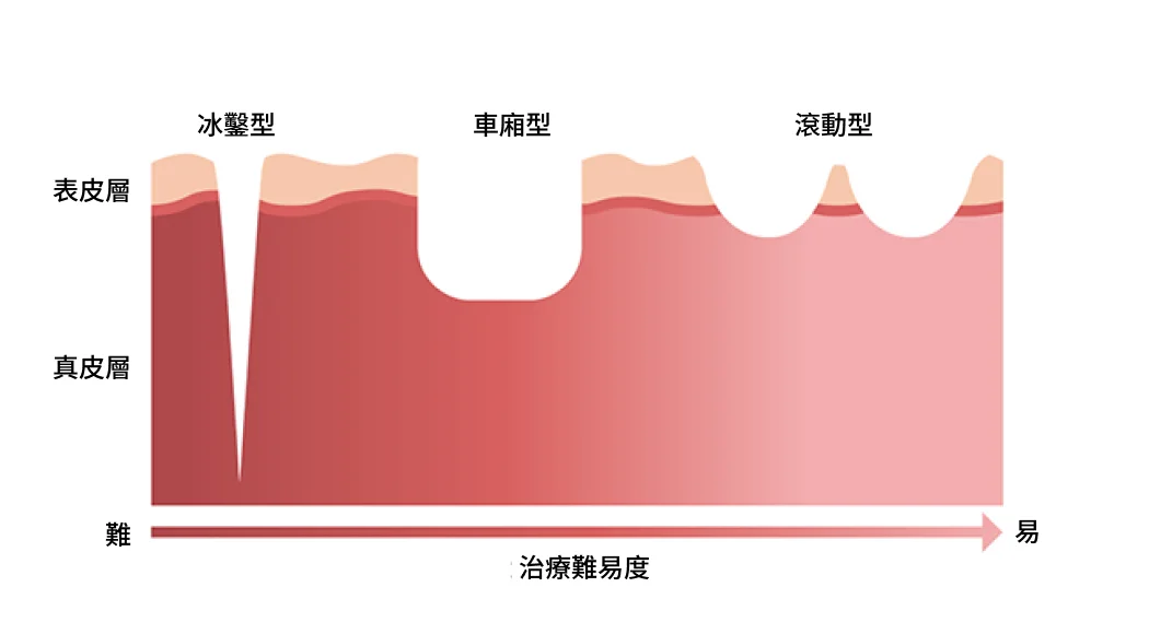 凹陷型痘疤的三種型態