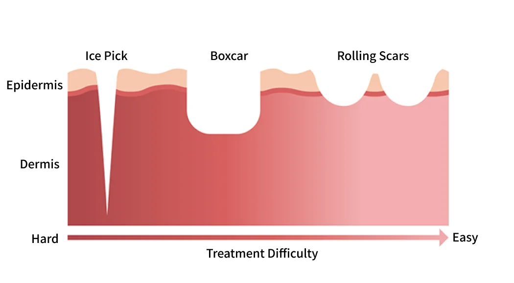 Three Types of Pitted Acne Scars