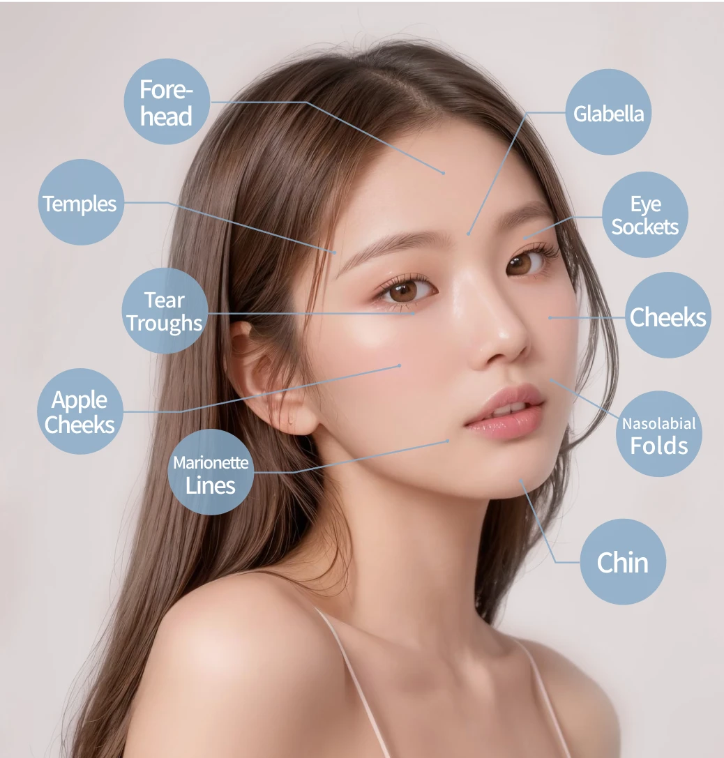 Applicable Areas - Forehead, Temples, Tear Troughs, Apple Cheeks, Marionette Lines, Glabella, Eye Sockets, Cheeks, Nasolabial Folds, Chin
