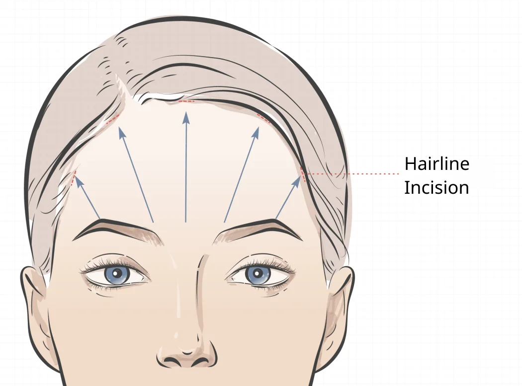 Upper Face Lift Surgery Diagram