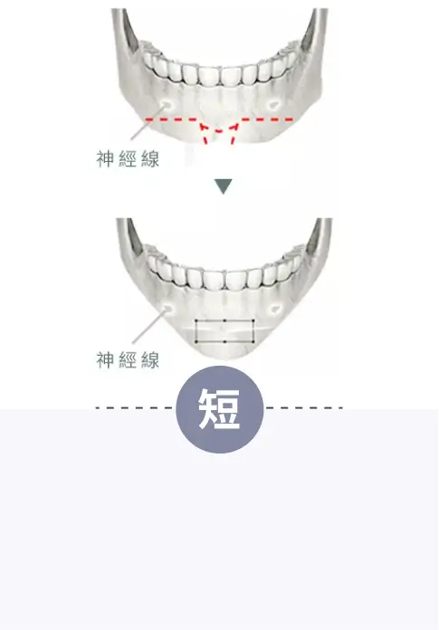 短下巴問題-削骨手術