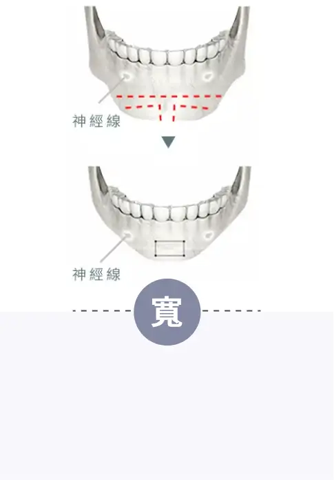 寬下巴問題-削骨手術