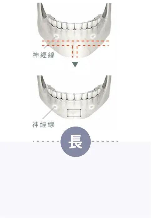 長下巴問題-削骨手術