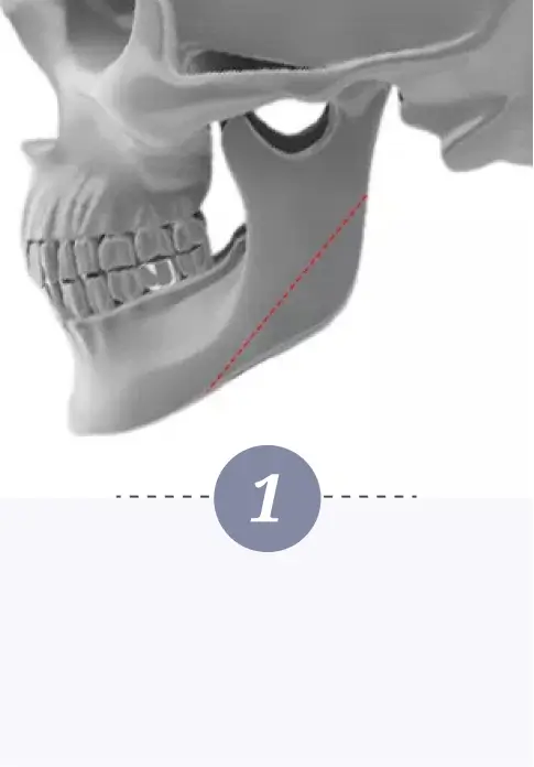 Jawbone Contouring Step 1