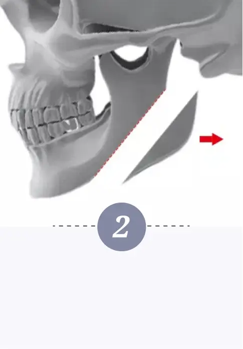 Jawbone Contouring Step 2