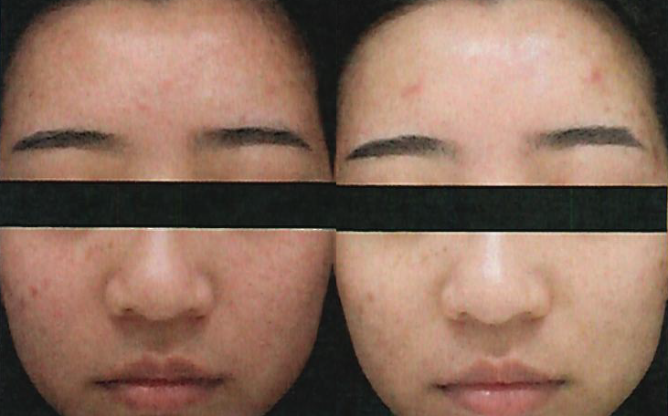 酷雪 Glacial SPA 淡斑煥亮案例 — 左術前右術後 — 奈思診所