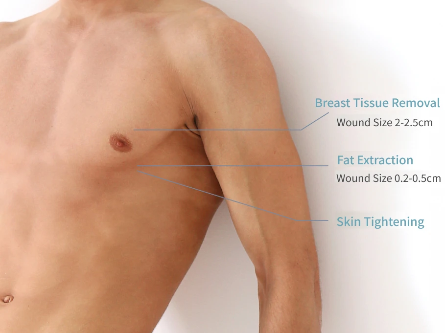 Gynecomastia Liposuction Procedure