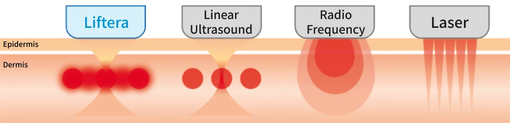 Liftera-V vs Linear Ultrasound, Radio Frequency, and Laser Treatments
