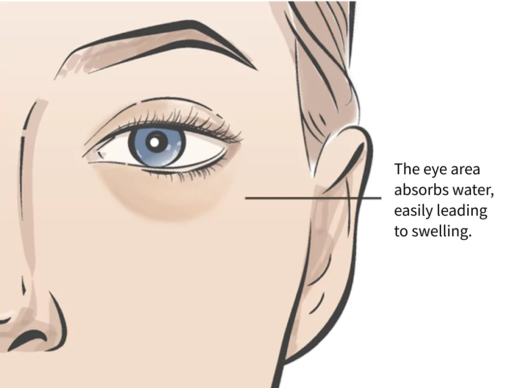 Edematous Eye Bags Illustration