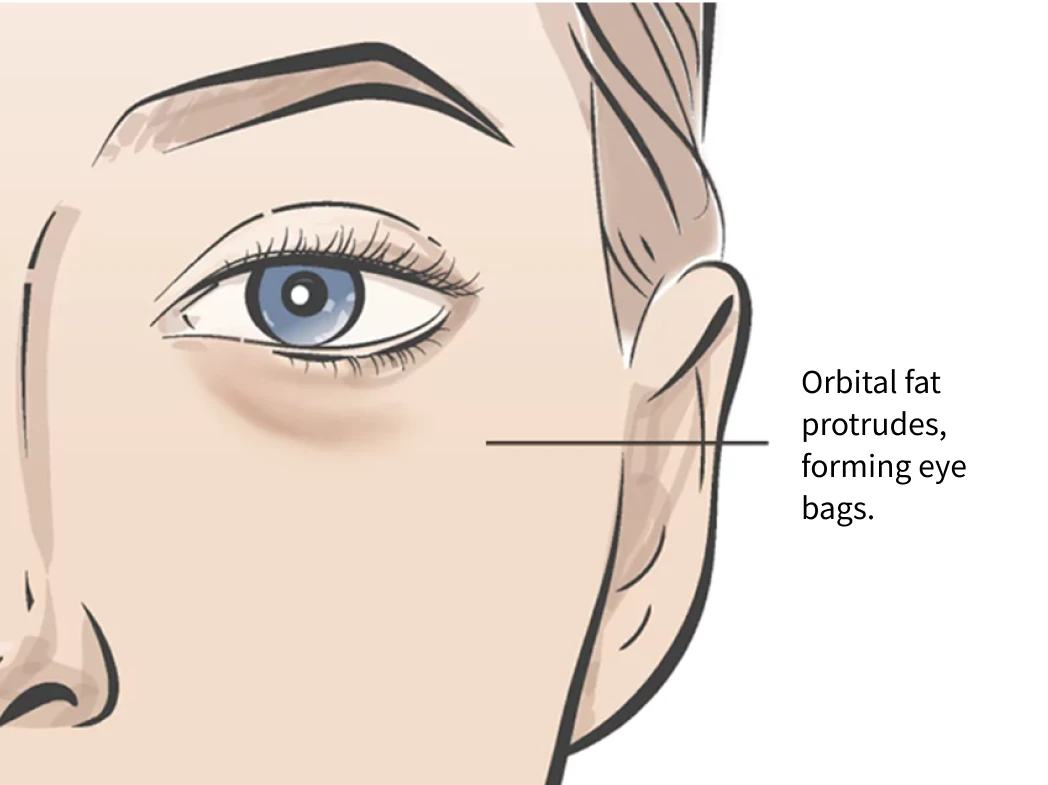 Genetic Eye Bags Illustration