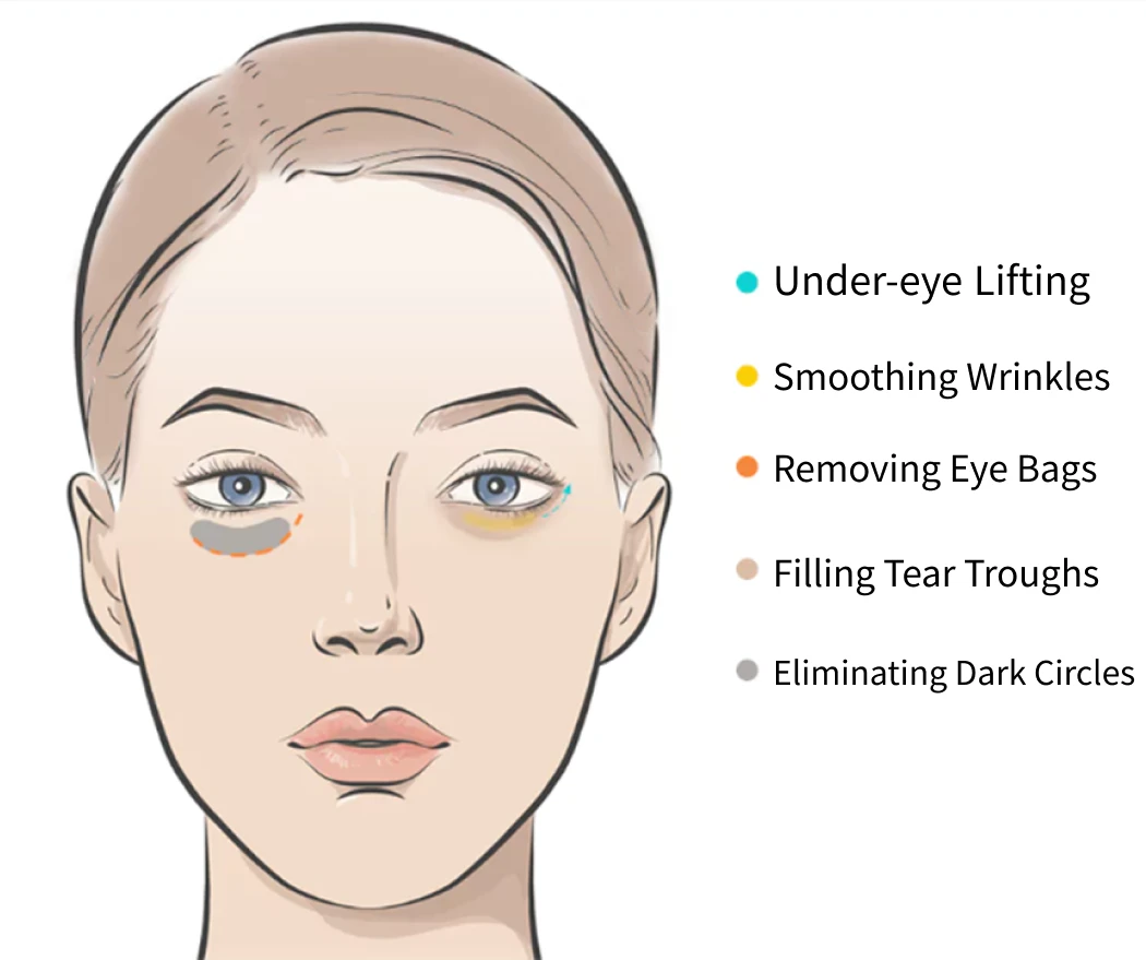 5-in-1 Invisible Scar Blepharoplasty key points image