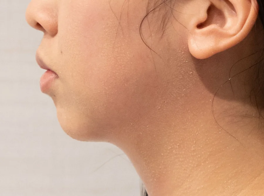 雙下巴 Onda Pro 昂達超微波術後（After）