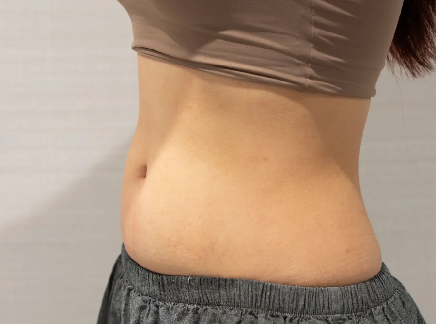 腹部脂肪 Onda Pro 昂達超微波術後（After）