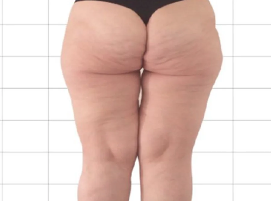 橘皮組織 Onda Pro 昂達超微波術後（After）