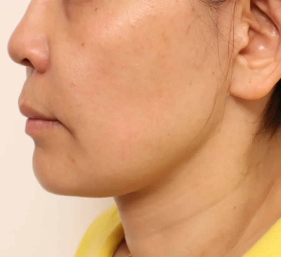 臉部輪廓線條 Onda Pro 昂達超微波術後（After）