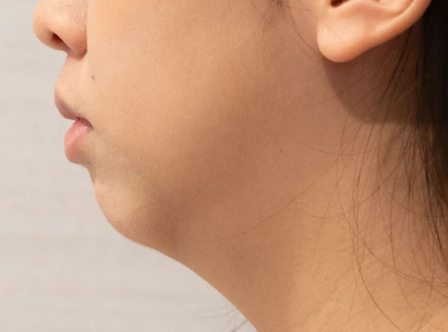 雙下巴 Onda Pro 昂達超微波術前（Before）