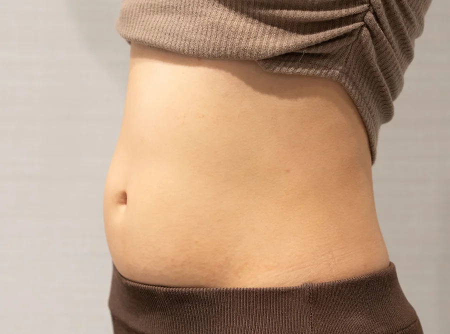 腹部脂肪 Onda Pro 昂達超微波術前（Before）