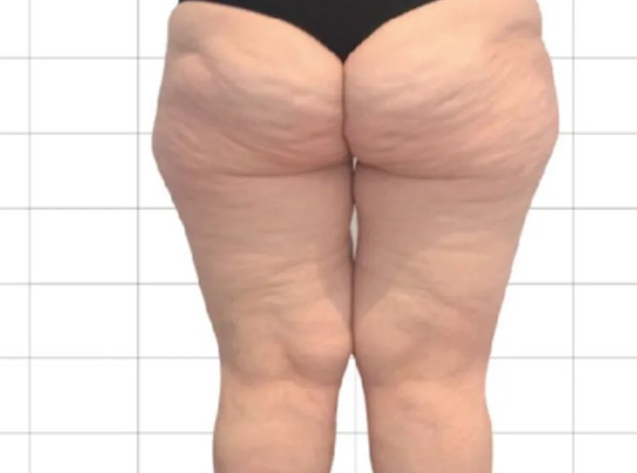 橘皮組織 Onda Pro 昂達超微波術前（Before）