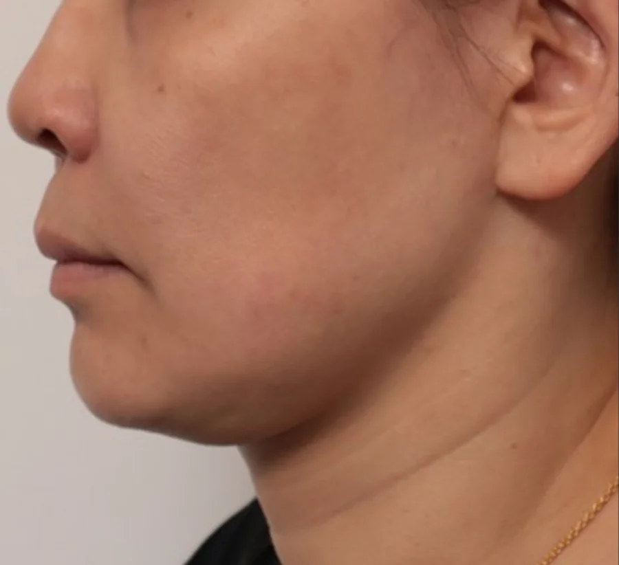 臉部輪廓線條 Onda Pro 昂達超微波術前（Before）