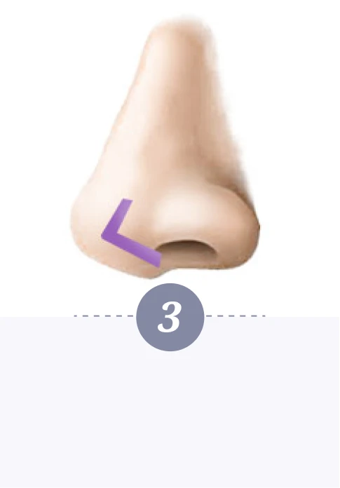 自體肋骨珍珠隆鼻-第三步驟