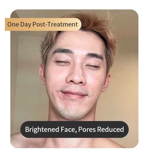 One Day Post-Treatment Photo of KOL
