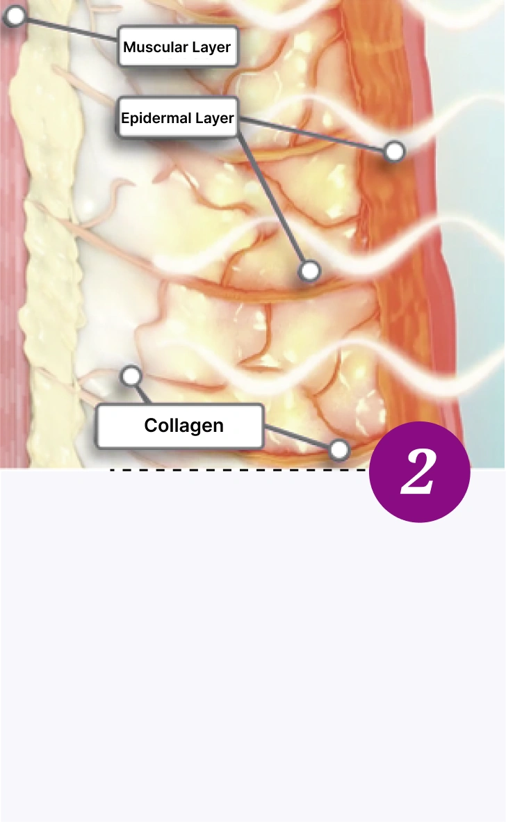 Thermage FLX - Step Two
