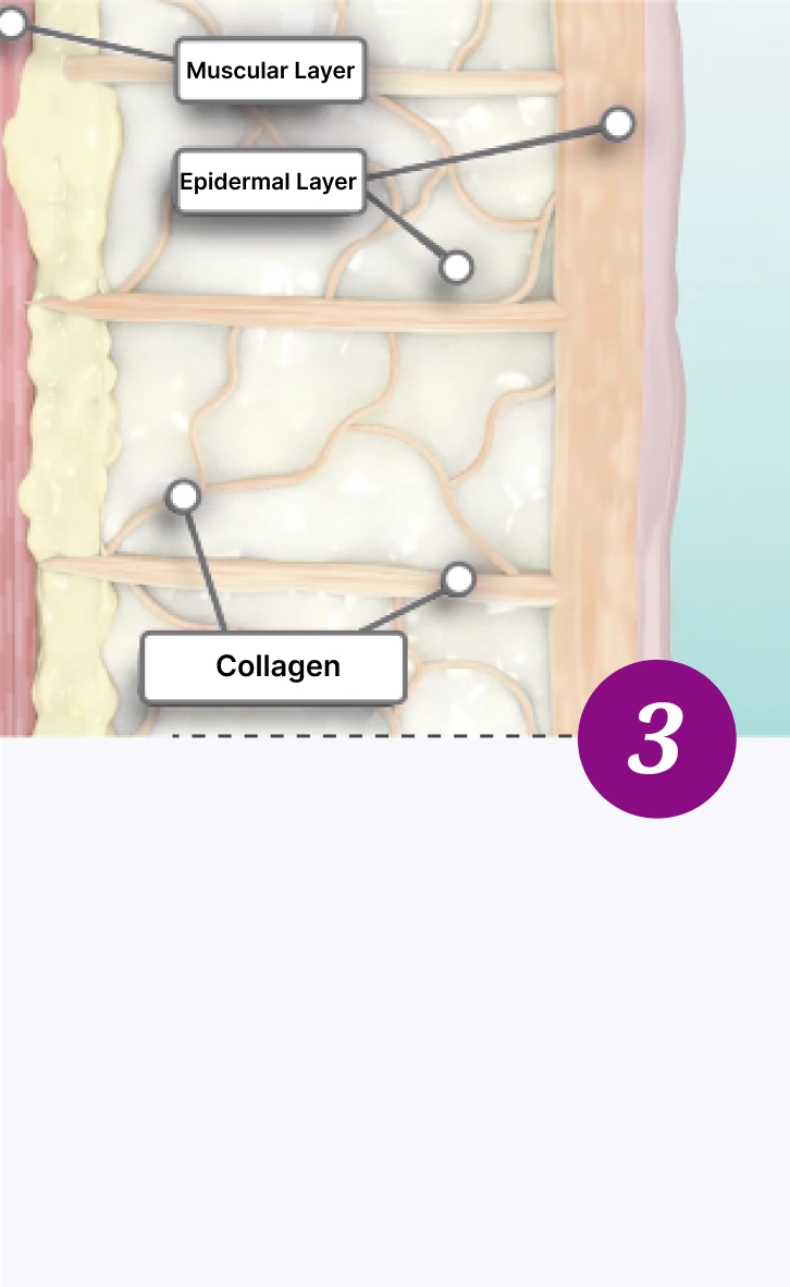 Thermage FLX - Step Three