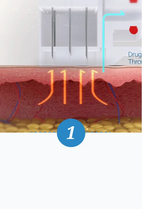 水光注射-第一步驟