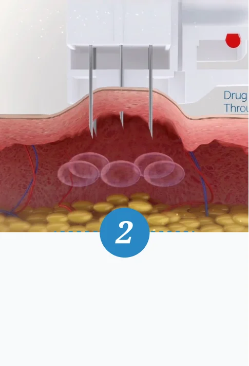 水光注射-第二步驟