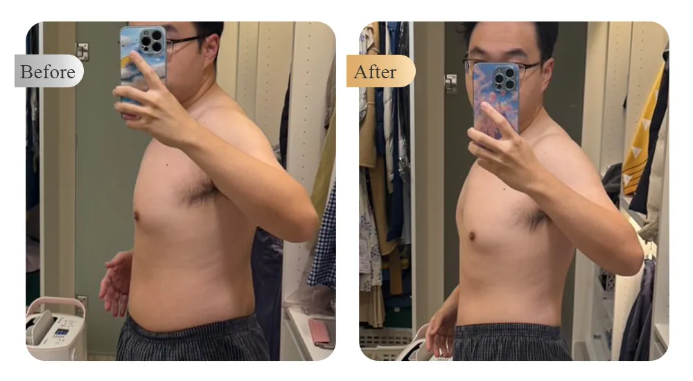 Naiss Clinic Medical Weight Loss Case — Male Abdomen Before & After