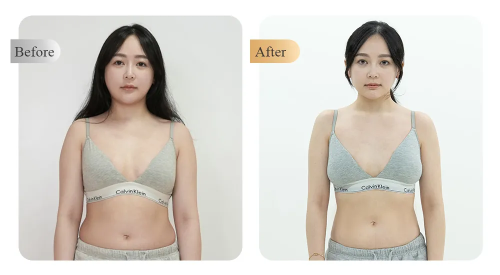 Naiss Clinic Medical Weight Loss Case — Female Waist Before & After
