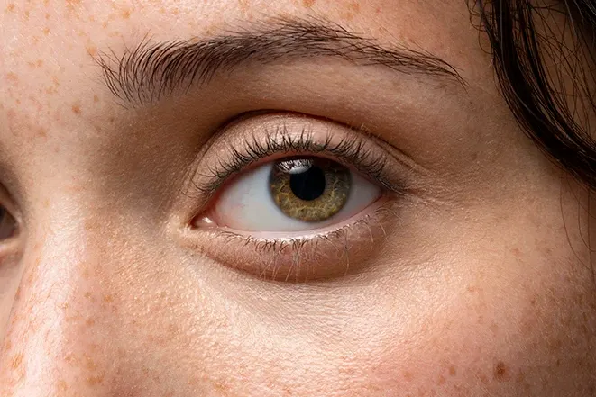 Filling Tear Troughs With Hyaluronic Acid: 5 Things to Know