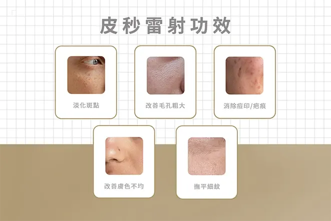 皮秒雷射功效