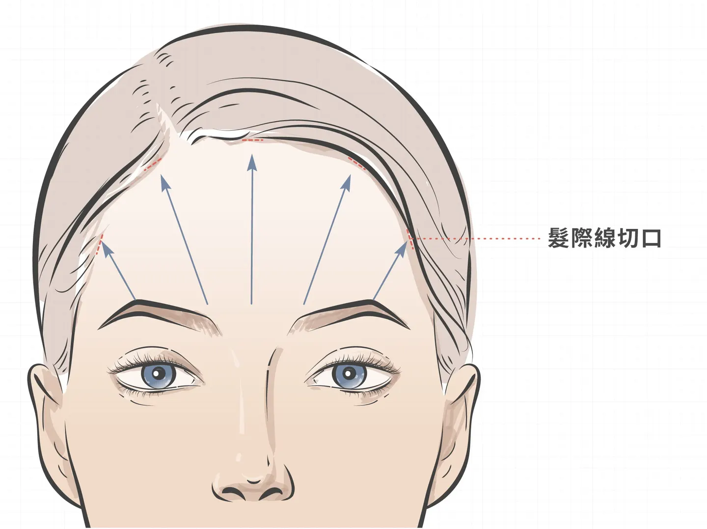 前額拉皮手術