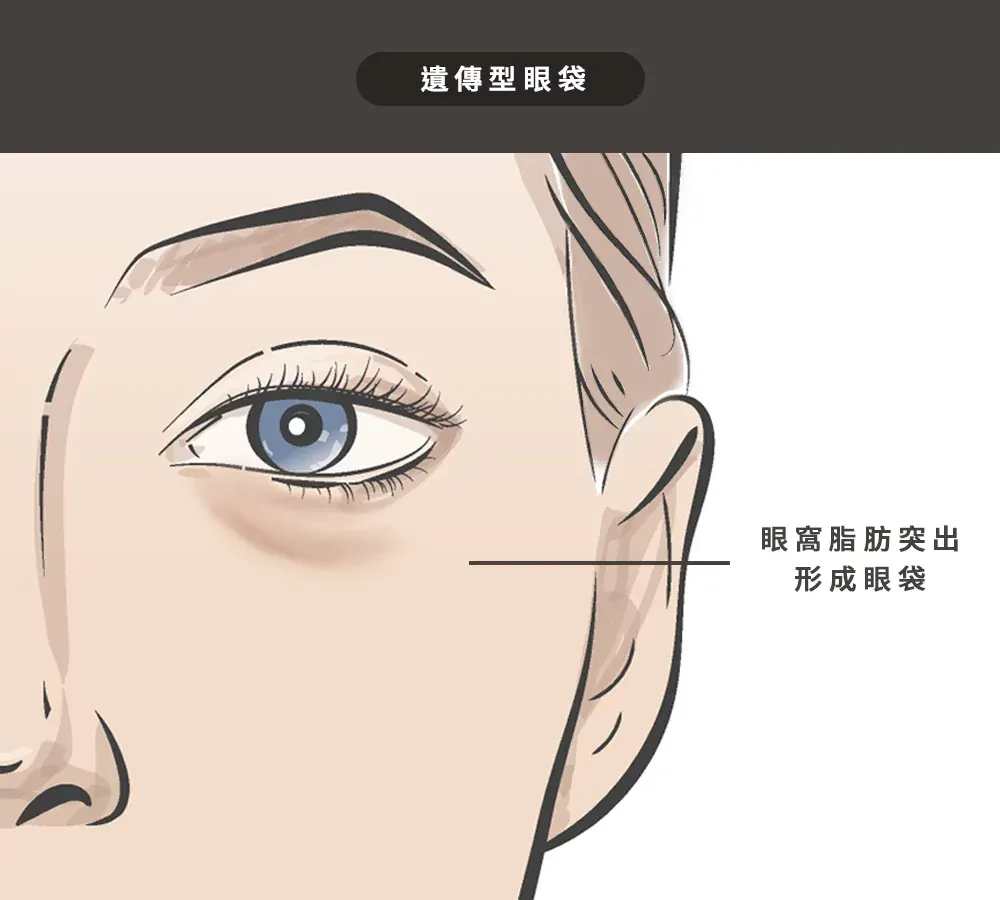 2、遺傳型眼袋