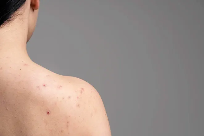 Back Acne Everywhere? Causes, Care, and a Clear-Back Guide