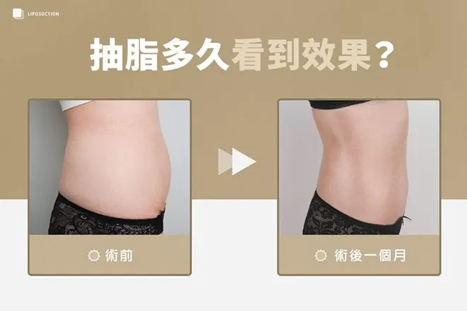 抽脂多久見效