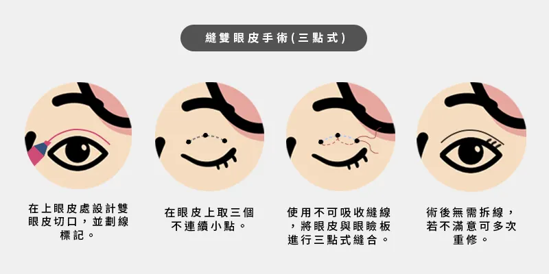 三點式雙眼皮