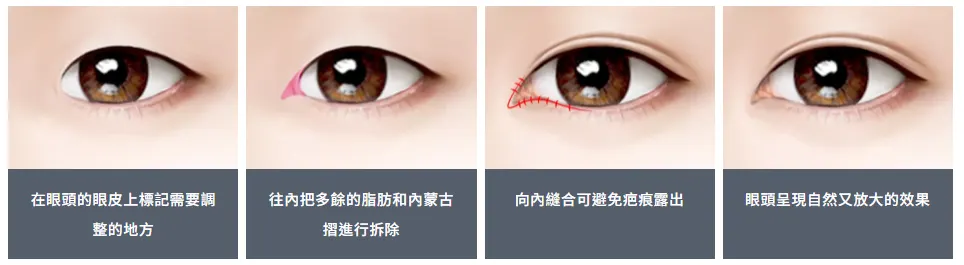 開眼頭是什麼？可以改善蒙古摺？