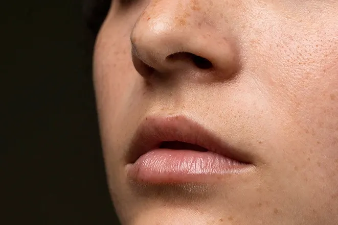 Enlarged Pores: Can Lasers Really Shrink Them?