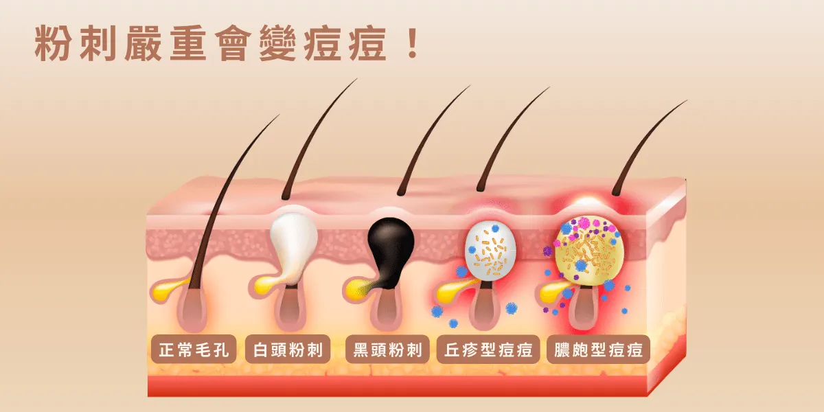 若「白頭粉刺」「黑頭粉刺」在此時處理不當或放任不管，致使痤瘡桿菌增生，引起局部發炎，就會變成紅腫或化膿的痘痘，形成「丘疹型痘痘」「膿皰型痘痘」最終可能形成無法挽回的凹疤。

若再加上老化、生活作息不正常導致毛囊周圍膠原蛋白和彈性蛋白流失無法支撐、推擠毛孔壁就會導致毛孔空間變大，再形成「毛孔粗大」...到時候想要在做任何醫美療程來挽救無疑都要讓荷包大失血，所以，我們該在粉刺醞釀期的時候就先下手為強，給予強力有效的處置方案！