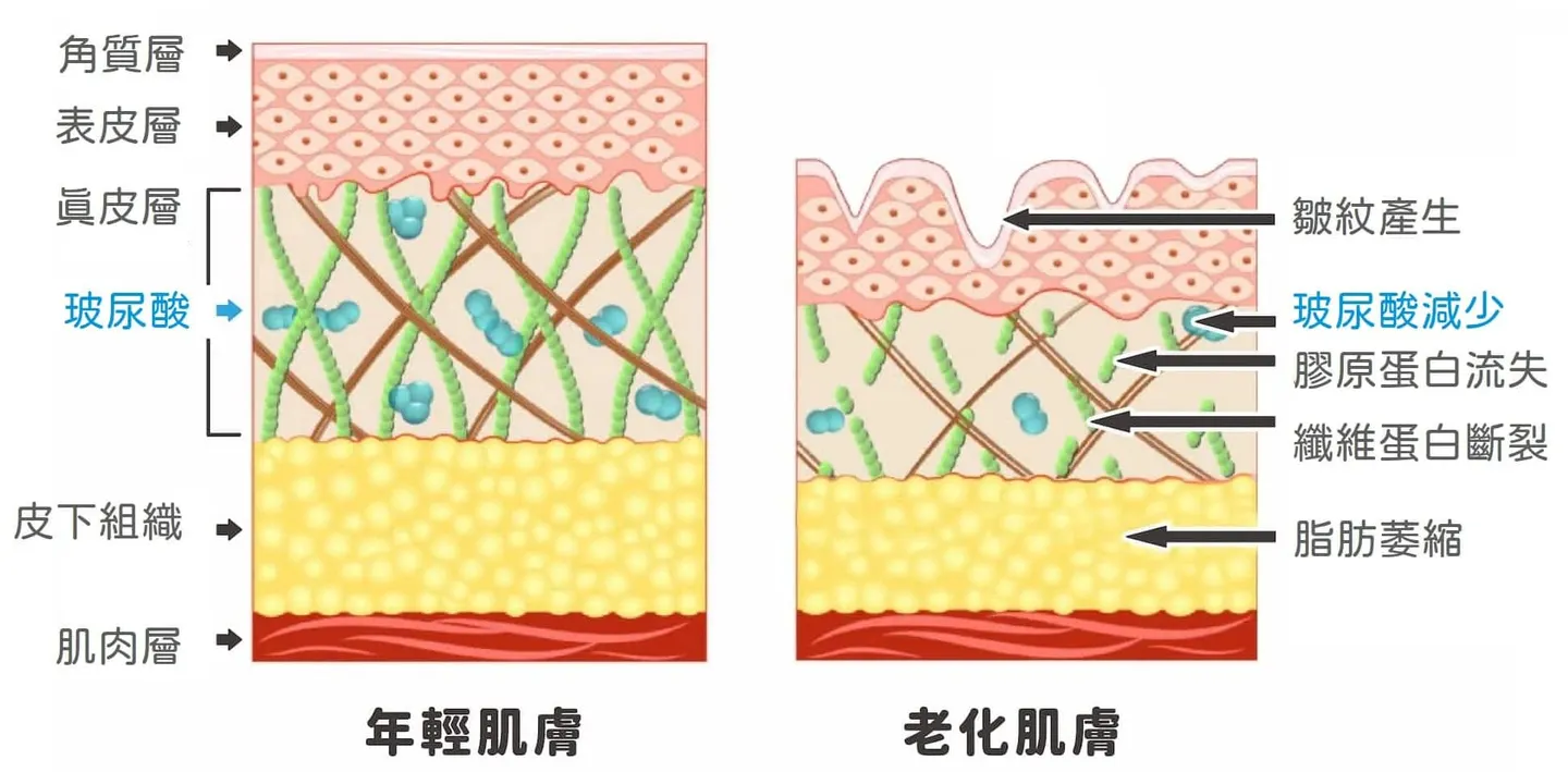Did you know?

Hyaluronic acid naturally exists in our bodies! Young skin is elastic because of hyaluronic acid in its collagen-like form, together with the collagen that supports the skin, and both gradually decline with age. Combined with the effects of gravity, the skin starts to show laxity, hollowing, sagging, and wrinkles (nasolabial folds, marionette lines, and so on)!